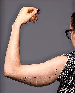 ARM LIFT (BRACHIOPLASTY)