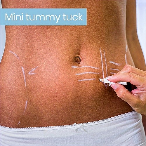 MINI TUMMY TUCK