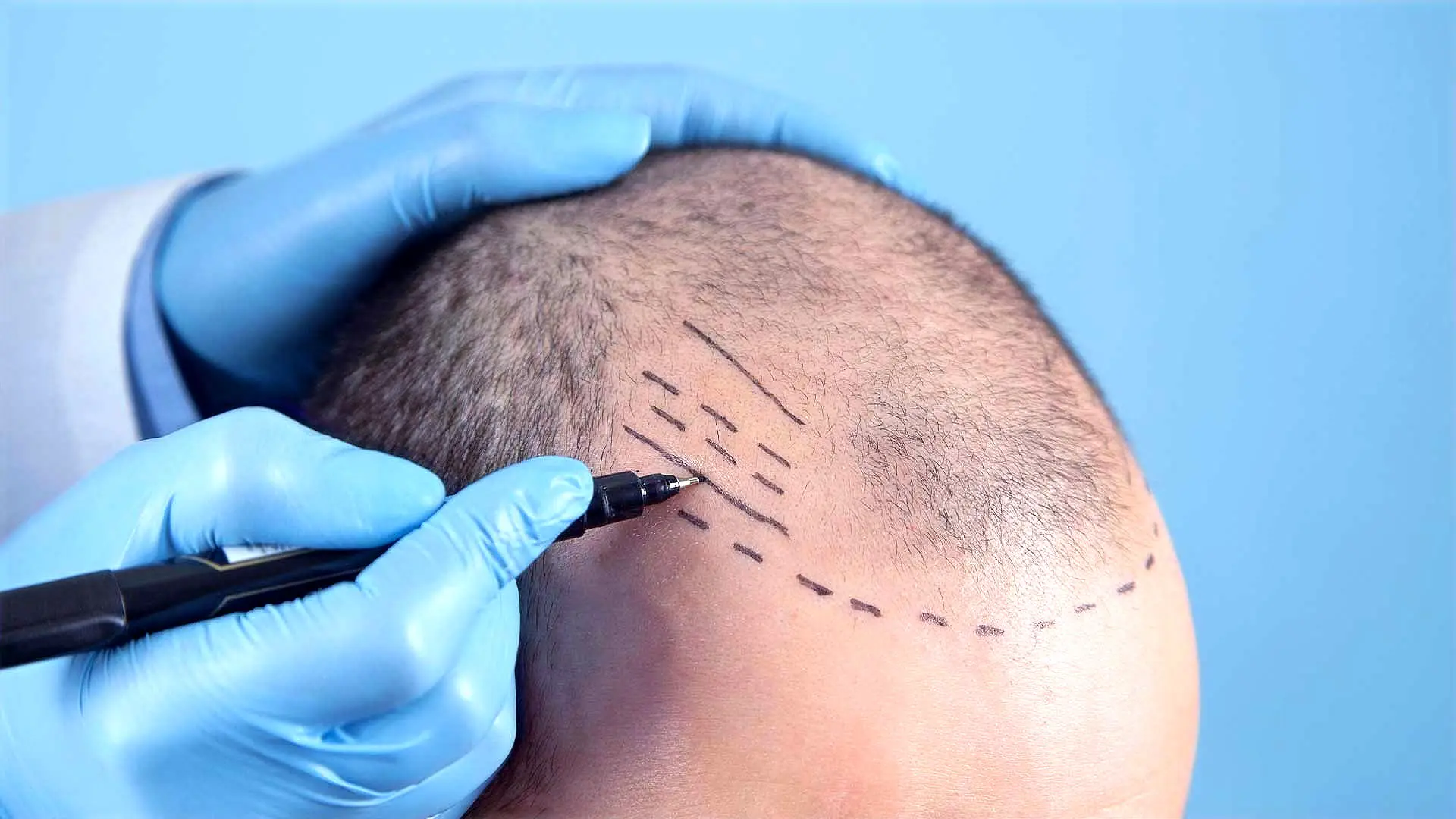 HAIR TRANSPLANT
