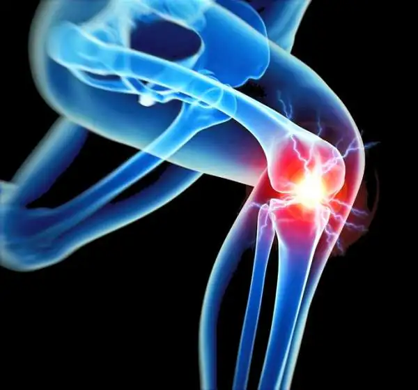 FULL KNEE REPLACEMENT